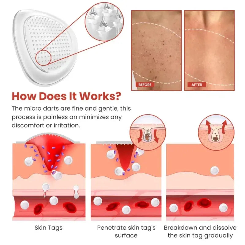 Derma Smooth Skin Tag Removal Patch | Secret to Spotless Skin ✨