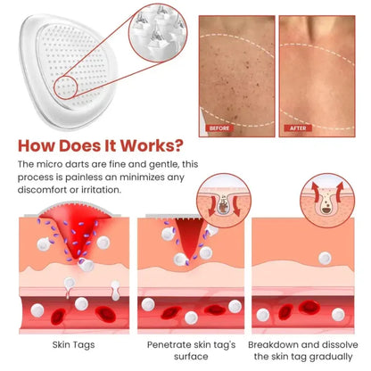 Derma Smooth Skin Tag Removal Patch | Secret to Spotless Skin ✨